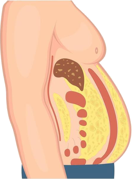 Cross-section illustration showing high visceral fat around the organs